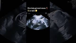 Ultrasound scan In Pregnancy [upl. by Lory705]