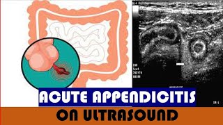 Acute appendicitis on Ultrasound [upl. by Aehtorod]