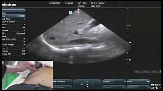 Hot Tips  IVC Volume Assessment with Ultrasound [upl. by Joletta301]