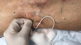 Treating Reticular Veins with Foam Sclerotherapy [upl. by Enilrac]