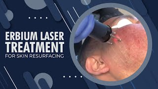 Erbium Laser Treatment for Skin Resurfacing  Beverly Hills CA [upl. by Nevet]