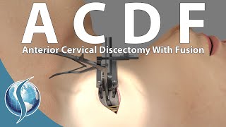 Anterior Cervical Discectomy and Fusion [upl. by Enaz]