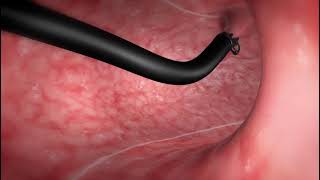 Endoscopic Sleeve Gastroplasty ESG Procedure [upl. by Hareema]