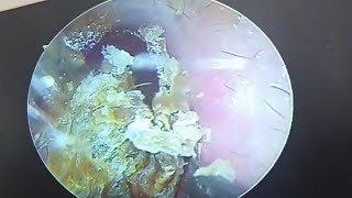 Processing fungal thick dry patches on the eardrum earwax Cleaning earwaxremoval doctoranh [upl. by Slyke]