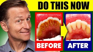 Natural Solution for Plaque Cavities and Gingivitis [upl. by Eicyal]