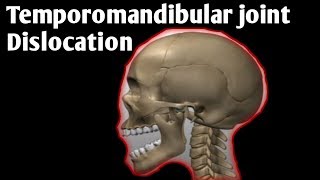 Dislocation of mandibular Dislocation of the Temporomandibular Joint TMJ [upl. by Alysoun]