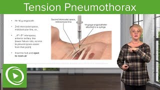 🚨 Tension Pneumothorax Critical Diagnosis amp Treatment Explained [upl. by Ecirtram]