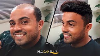 Aplicação de Prótese Capilar Masculina PROCAP HAIR [upl. by Franck]