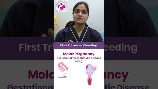 Is Molar Pregnancy or GTD Causing Your Bleeding During Pregnancy Dr Mayuri Kothiwala’s Guide [upl. by Rehportsirhc790]