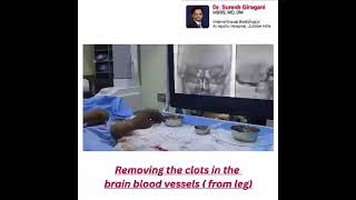 Thrombectomy for Stroke Dr Suresh Giragani’s LifeSaving Procedure Explained [upl. by Edy662]