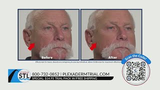 Smooth out your fine lines with Plexaderm for only 1495 [upl. by Laerol]