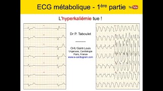 12a ECG métabolique 1 Hyperkaliemie Dr Taboulet [upl. by Kcirded]