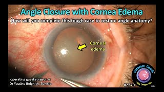 CataractCoach™ 2270 angle closure glaucoma with corneal edema [upl. by Crudden28]