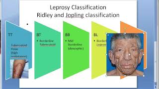 Pathology 160 a Leprosy Classification Difference Tuberculoid Lepromatous Ridley jopling TT BT BB LL [upl. by Noired]