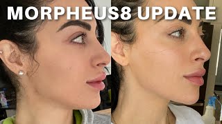 INMODE MORPHEUS8 RESULTS UPDATE 23 TREATMENTS IN [upl. by Celene]