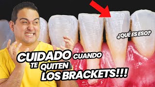 LO QUE NADIE TE DICE SOBRE EL RETIRO DE TUS BRACKETS  CUIDADO CUANDO TE QUITEN LA ORTODONCIA 😑 [upl. by Zanze]