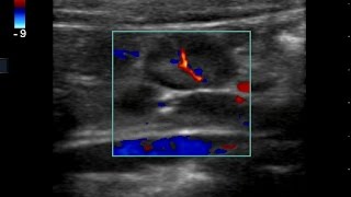 Mesenteric Adenitis in a 5 yo Girl with Intermittent Abdominal Pain for 5 Days [upl. by Rawna]