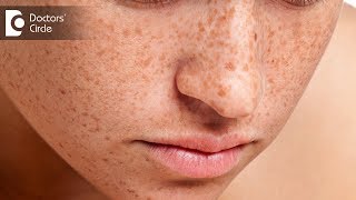 How To Get Rid Of Freckles Naturally and Fast [upl. by Gnivri]