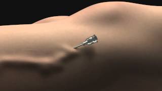 No  Knife Endovenous Laser  Animation of Scarless Varicose Vein Treatment [upl. by Fesoj670]