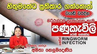 පණුකැවිලි රෝගය හෙවත් Ringworm infection සදහා ප්‍රතිකාර  Skin Specialist [upl. by Carrew]