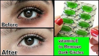 Remove Dark Circles in 3 days with Vitamin E 100 Works [upl. by Asyral]