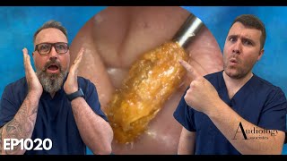 EAR WAX PLUG REMOVAL EAR CANAL CHOLESTEOTOMA AND OPINION ON THE RAI HOOK  EP1020 [upl. by Flossy]