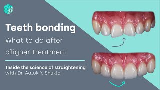 Teeth bonding  what to do after aligner treatment  Inside the science of teeth straightening [upl. by Lazar]