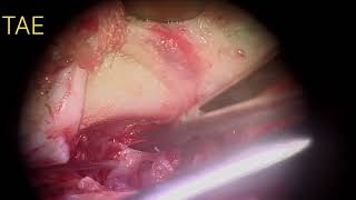 Total Annular Excision Tympanoplasty  Temporalis fascia graft tympanoplasty TAE earperforation [upl. by Rosina]