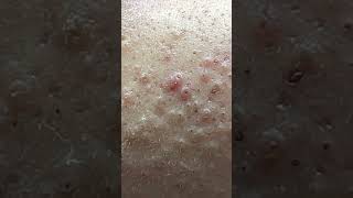 Lets Count Acnes  ACNE TREATMENT MAI NGOC FAMILY 💕💕  ACNE TREATMENT MAI NGỌC  demo [upl. by Serdna590]