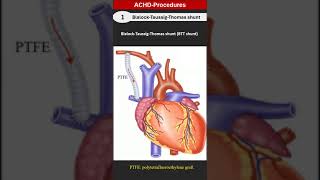 ACHD Procedures 1 BlalockTaussig shunt [upl. by Ecnadnak]