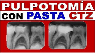 TRATAMIENTOS ENDODONCIA NO INSTRUMENTADOS INFANTILES DIENTES TEMPORALES [upl. by Aiet]