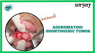 ENUCLEATION OF ADENOMATOID ODONTOGENIC TUMOR  REAL TIME SURGERY [upl. by Worrell]