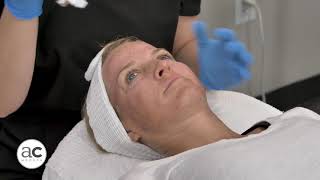 INTRAcel Treatment Demo at AesthetiCare [upl. by Ardys178]