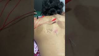 Needling therapy for pain relief physiotherapyequipment  needling therapy [upl. by Slinkman]