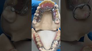 Metal Partials ​⁠EnvisiontecMain envisiontec lsk121shorts dentist dentistteeth [upl. by Busby]