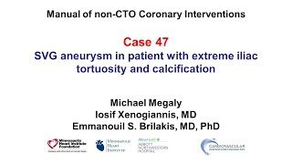 Case 47 PCI Manual  SVG aneurysm and iliac tortuosity [upl. by Inajar]