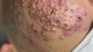 Satisfying and Relaxing with Squeezing Acne Acne Severe Hidden Acne Acne Treatment 19 [upl. by Idnaj309]