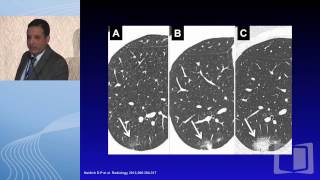 Screen discovered nodules What next [upl. by Dirgis]