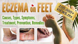 Eczema on foot Causes Symptoms Types Treatment Prevention and Home Remedies  Feet Eczema [upl. by Rockefeller]