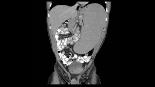 Hepatomegaly amp splenomegaly Hepatosplenomegaly by profMarwa AlEmam [upl. by Ariec701]