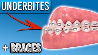 How Do Braces Fix Underbites  Premier Orthodontics [upl. by Anitirhc]