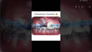 Ortho Treatment For Teeth advanceddentistry orthodontist orthodontics [upl. by Eimak]