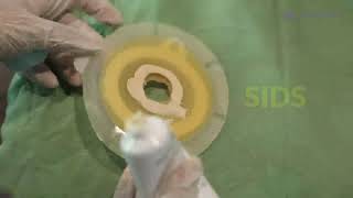 How to apply a stoma bag  Colostomy  Ileostomy bag  Change of stoma bag [upl. by Zrike722]