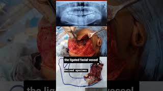 Case of Odontogenic keratocyst  OKC  Cyst of jaw  cystic lesion of jaw  Mandible Ressection [upl. by Elburr684]