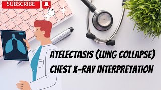 Chest X Ray Interpretation  5 Lung Collapse Atelectasis [upl. by Onitnelav]