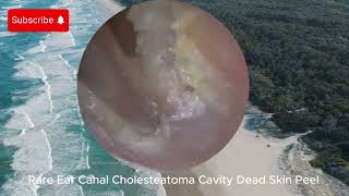 Rare Ear Canal Cholesteatoma Cavity Dead Skin Peel  EAR CLEANING [upl. by Murvyn]