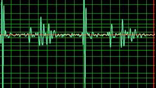 Minor Cardiomyopathy slow [upl. by Kirven]