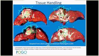 CAP education session Pediatric Hepatoblastoma Dr El Demellawy 2019 [upl. by Sturges715]