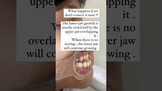 Lower jaw protrusion of a 5 year old  Treatment Procedure  Dr Dhivya Dilipkumar [upl. by Harris]