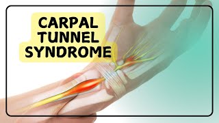 Carpal Tunnel Syndrome [upl. by Eelyab]